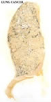 Lung cancer